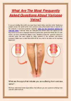 What Are The Most Frequently Asked Questions About Varicose Veins?