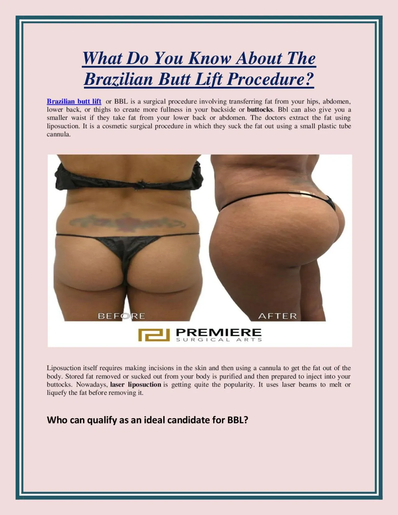 PDF-What Do You Know About The Brazilian Butt Lift Procedure?