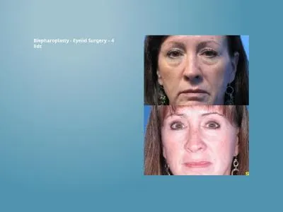 Blepharoplasty - Eyelid Surgery – 4 lids