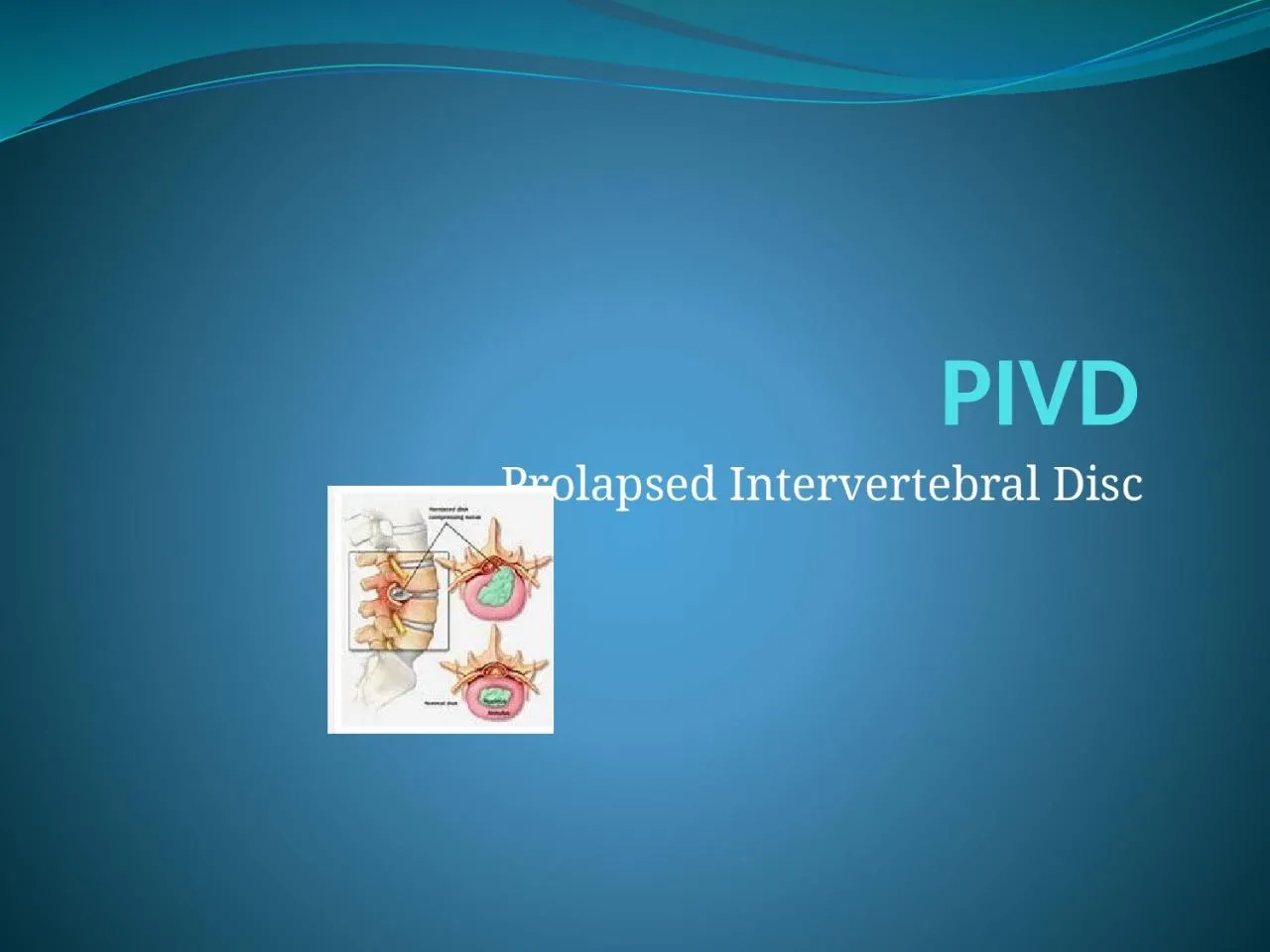 PPT-PIVD Prolapsed Intervertebral