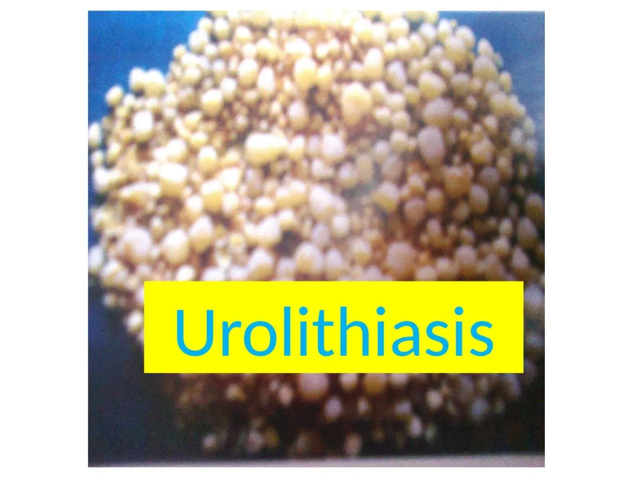 PPT-Urolithiasis Urolithiasis