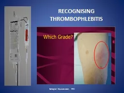 RECOGNISING THROMBOPHLEBITIS