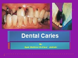 Dental Caries   By:  Syed