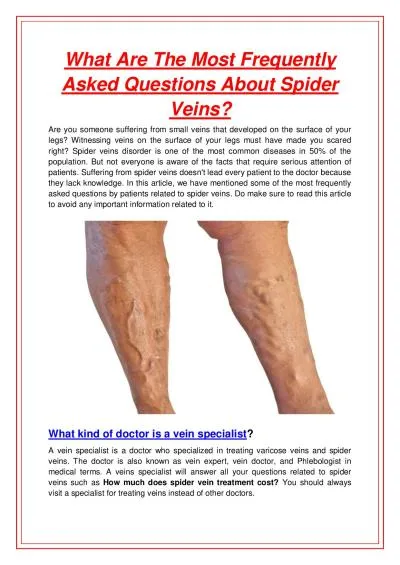 What Are The Most Frequently Asked Questions About Spider Veins?