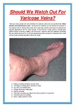 Should We Watch Out For Varicose Veins?