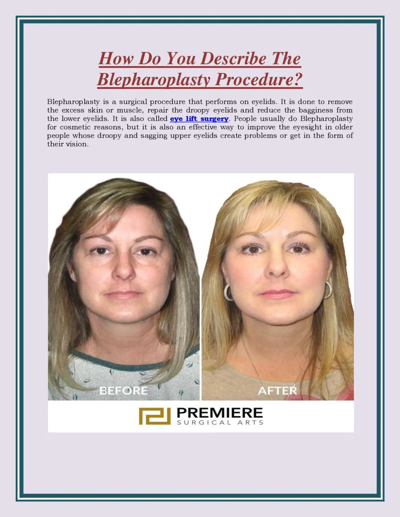 How Do You Describe The Blepharoplasty Procedure?