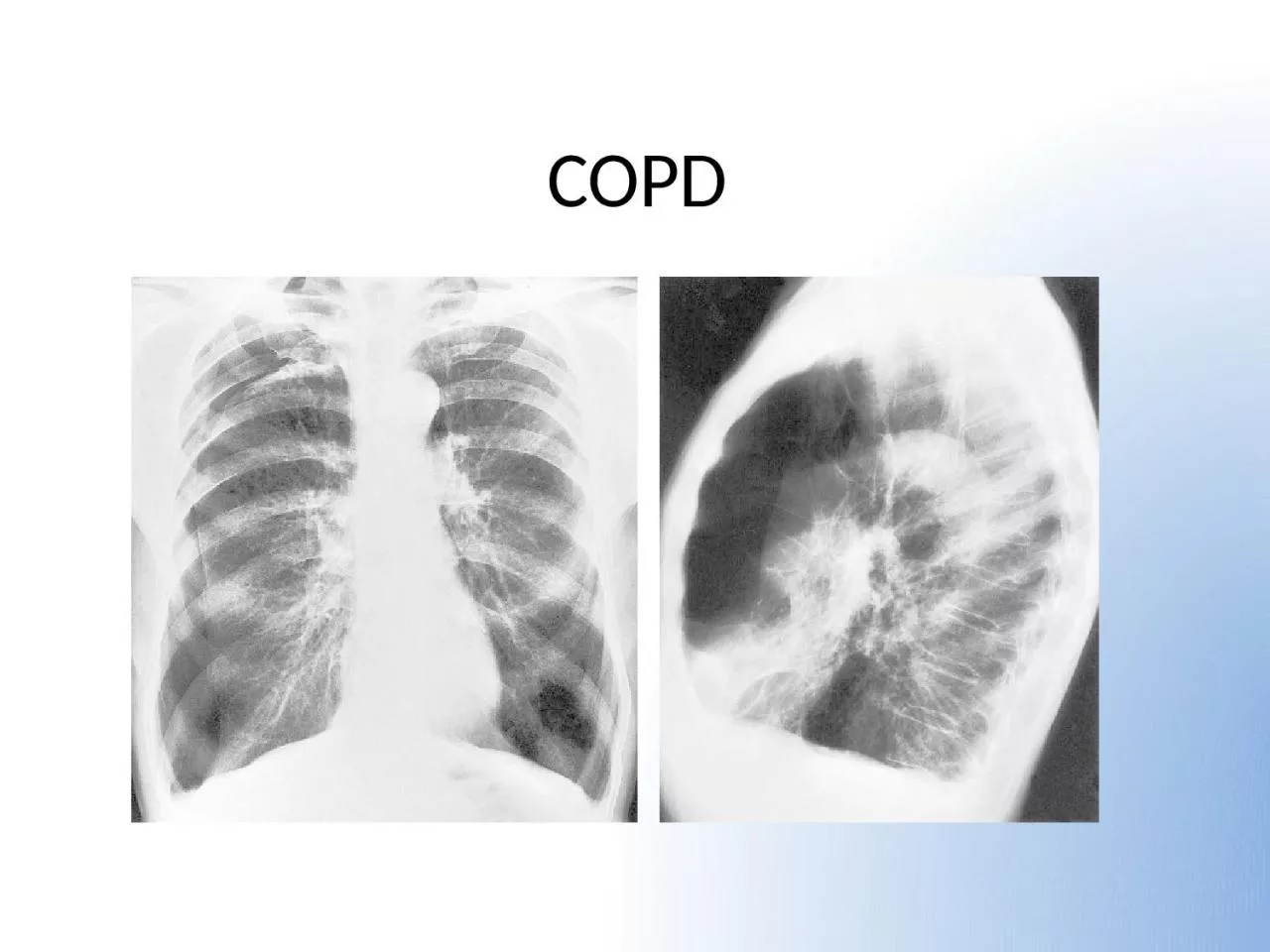 PPT-COPD Objectives How important is COPD?