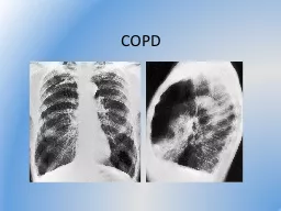 COPD Objectives How important is COPD?