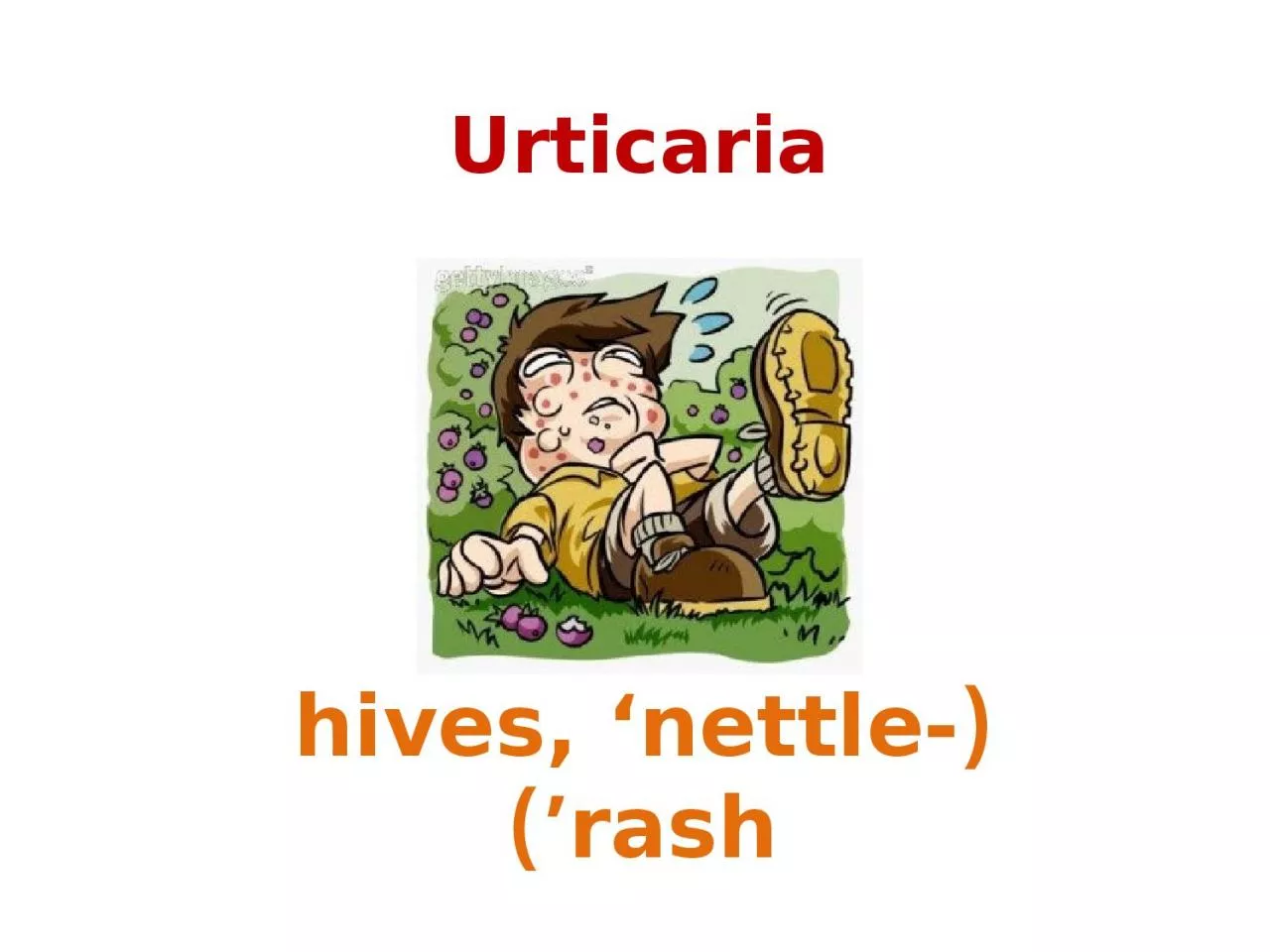 PPT-Urticaria (hives, ‘nettle-rash’)