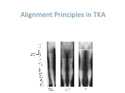 Alignment Principles in TKA