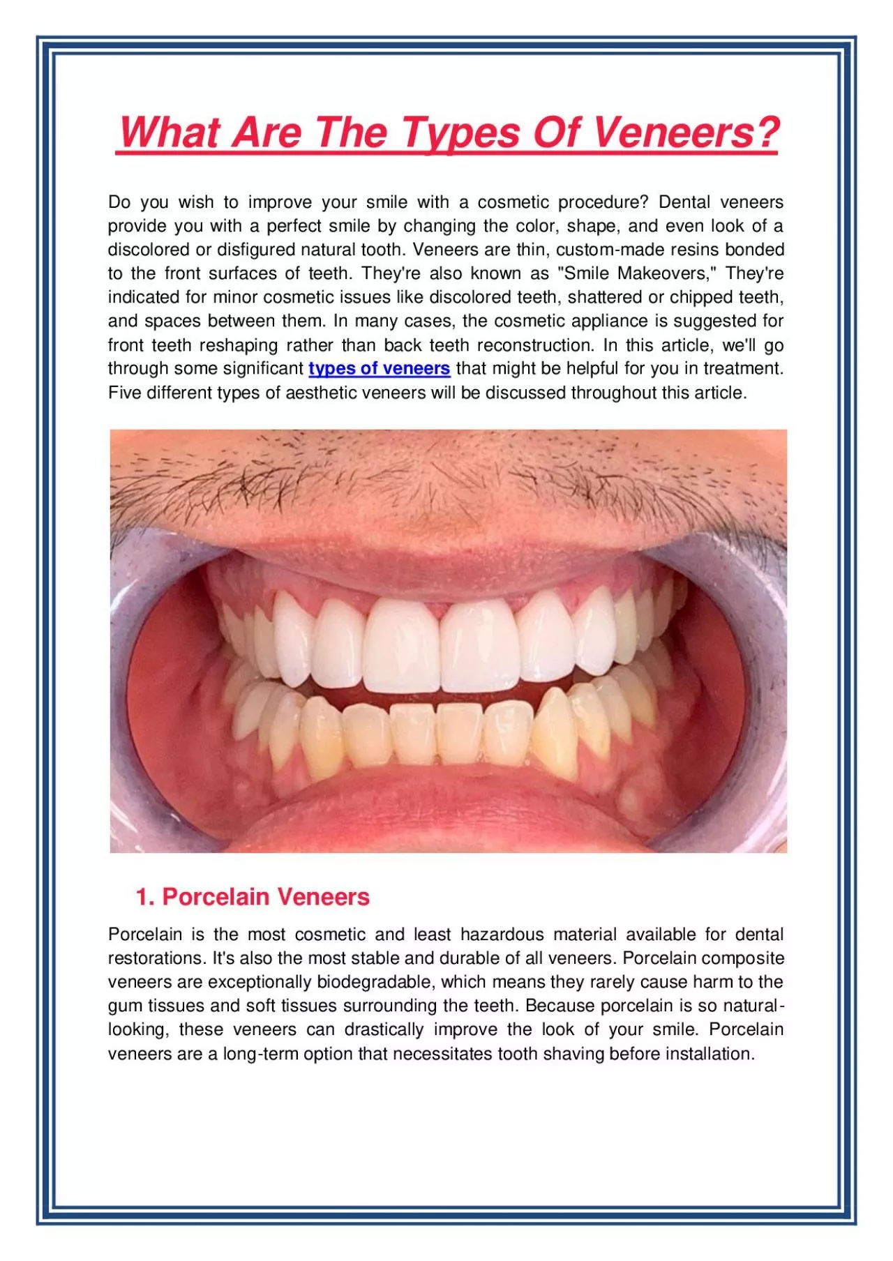 What Are The Types Of Veneers?