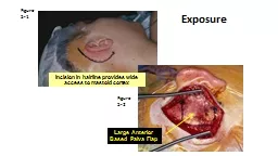 Incision in hairline provides wide access to mastoid cortex