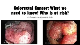 Colorectal Cancer : What we need to know! Who is at risk?