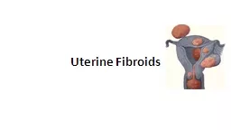 Uterine Fibroids   Quiz 1