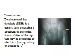 Introduction : Developmental hip dysplasia (DDH) is a generic term describing a