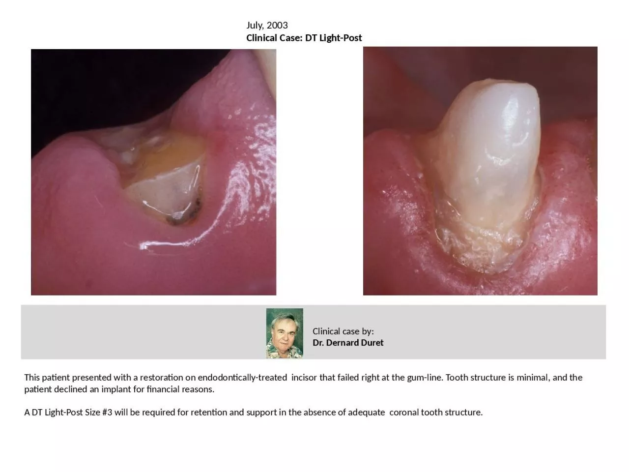 This patient presented with a restoration on endodontically-treated  incisor that failed