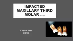 Impacted maxillary third molar