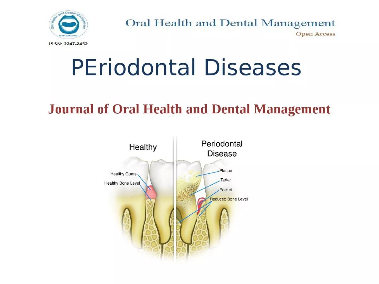 PPT-PEriodontal Diseases Journal of Oral Health and Dental Management