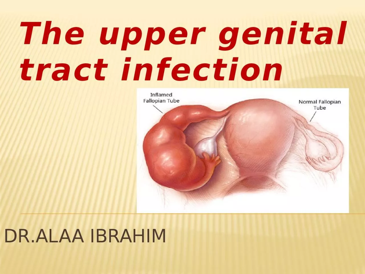 DR.ALAA IBRAHIM The upper genital tract infection