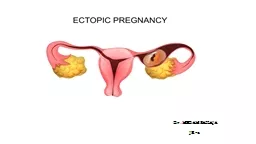 Dr.MEDAM  SAILAJA JR-3         DEFINITION: ECTOPIC PREGNANCY