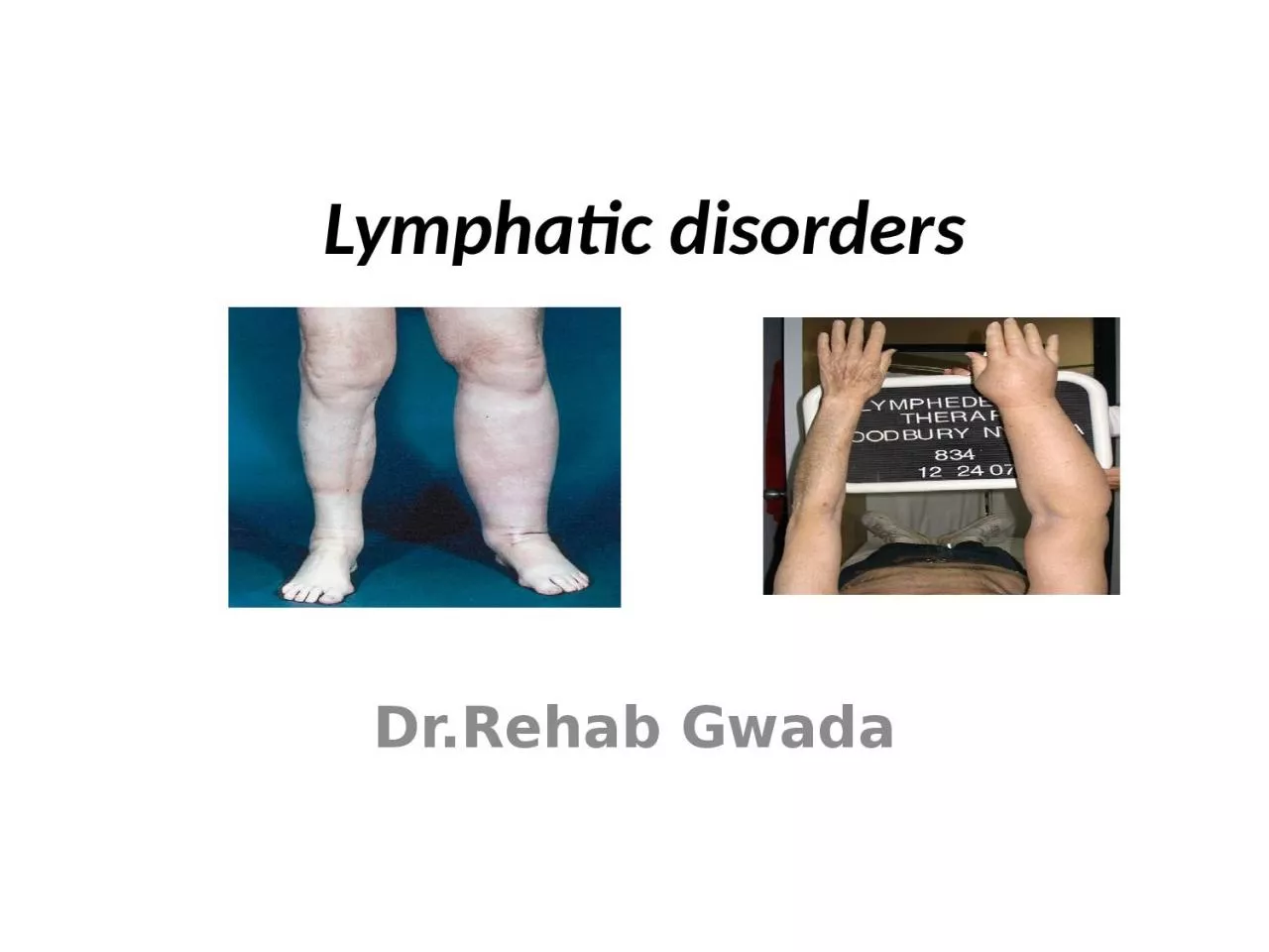 PPT-Lymphatic disorders Dr.Rehab