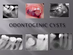 Odontogenic  Cysts What