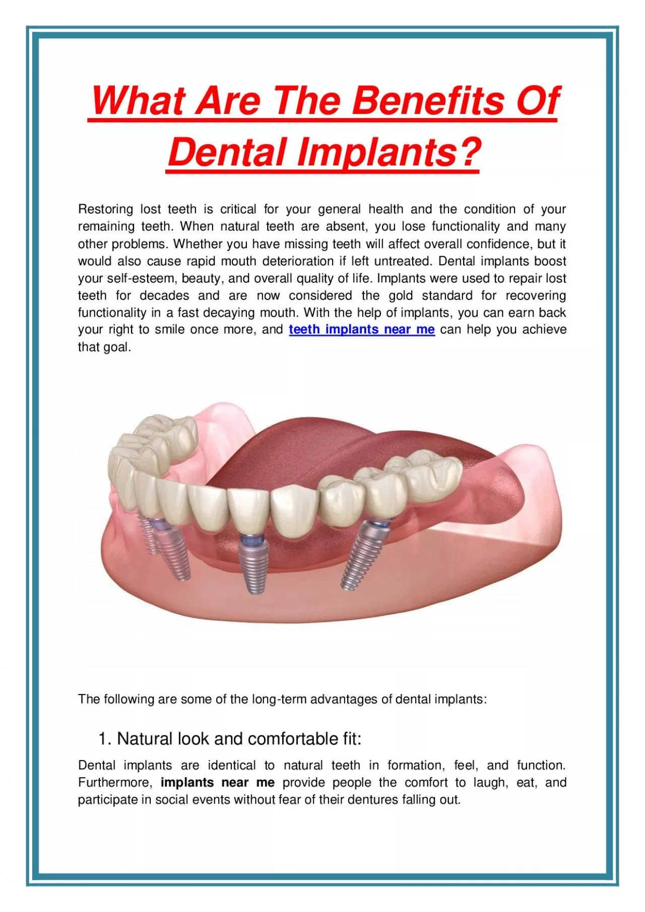 What Are The Benefits Of Dental Implants? 