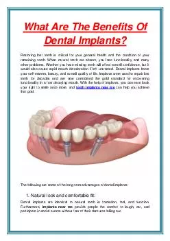 What Are The Benefits Of Dental Implants? 