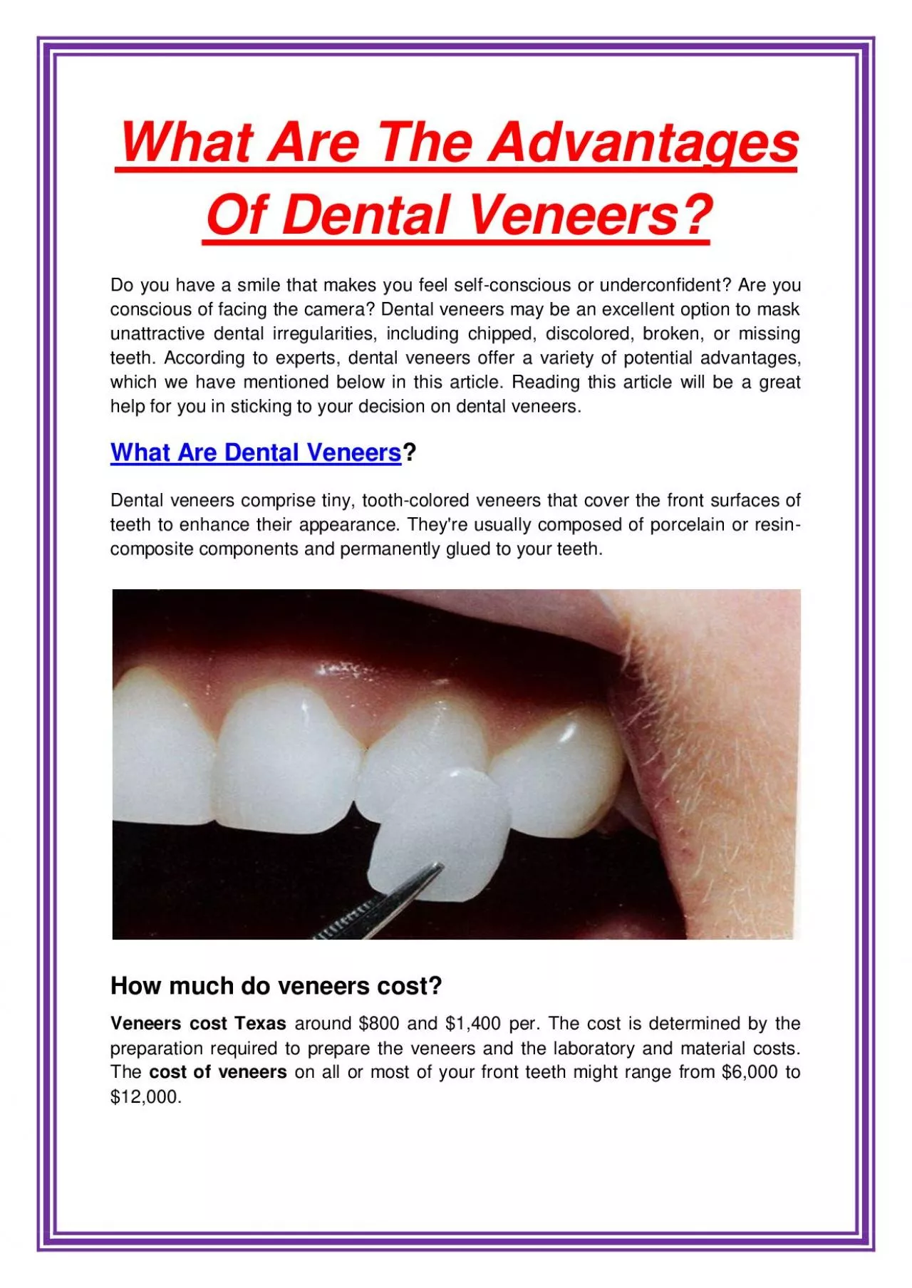 What Are The Advantages Of Dental Veneers?