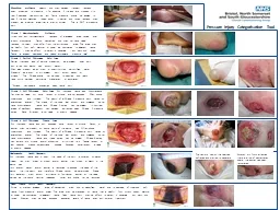 PPT-Blanching erythema : Healthy skin may develop transient redness when subjected to pressure