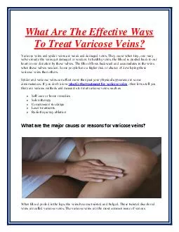 What Are The Effective Ways To Treat Varicose Veins?