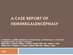 A CASE REPORT OF HEMIMEGALENCEPHALY