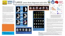 LARGE  Lesion Brain Alignment with AFNI