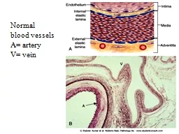 Normal  blood vessels A= artery