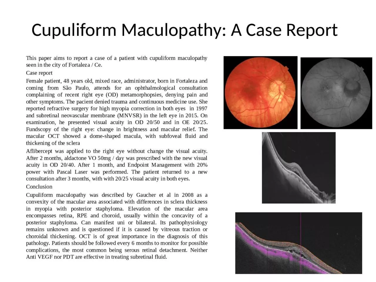 PPT-Cupuliform Maculopathy