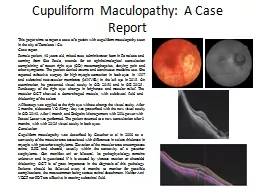 Cupuliform   Maculopathy