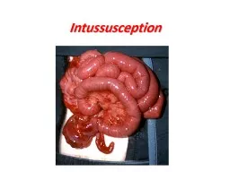 Intussusception