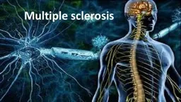 Multiple sclerosis   Multiple