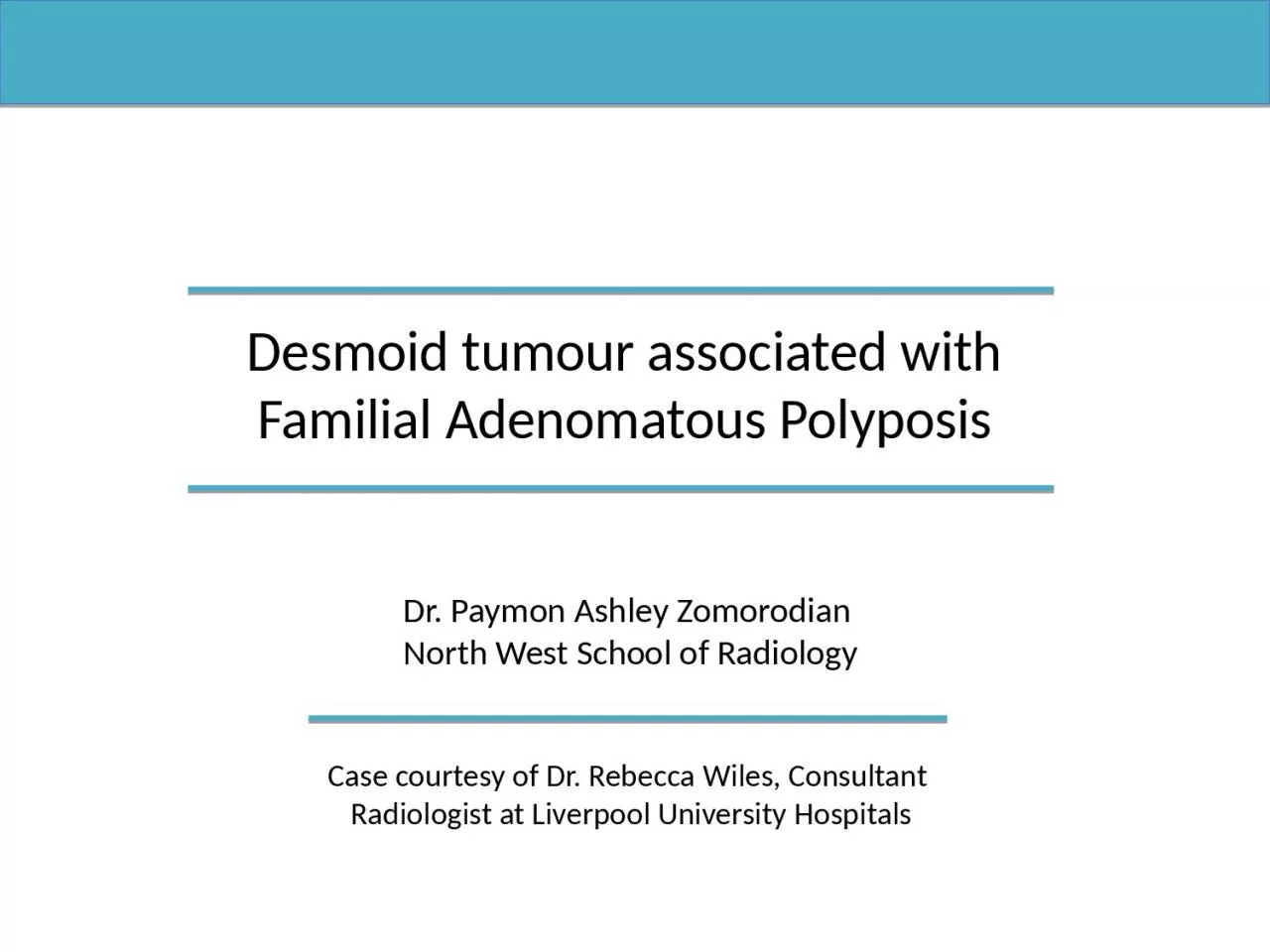 PPT-Desmoid t umour associated with