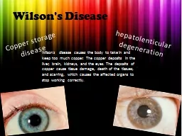 Wilson's Disease  hepatolenticular