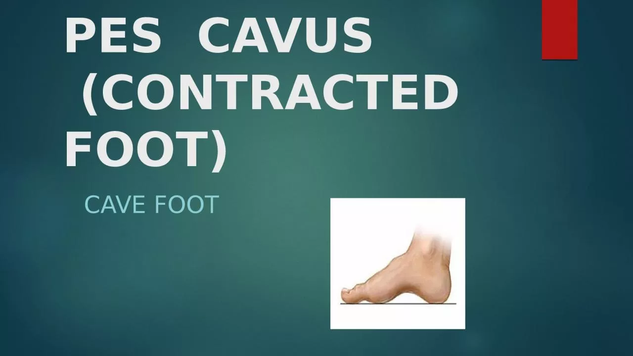 PES  CAVUS  (CONTRACTED FOOT)
