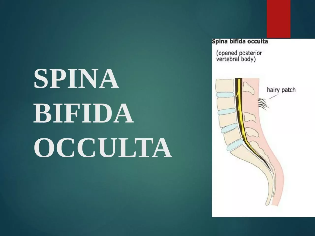 SPINA BIFIDA OCCULTA SPINA BIFIDA OCCULTA