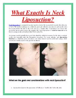 What Exactly Is Neck Liposuction?