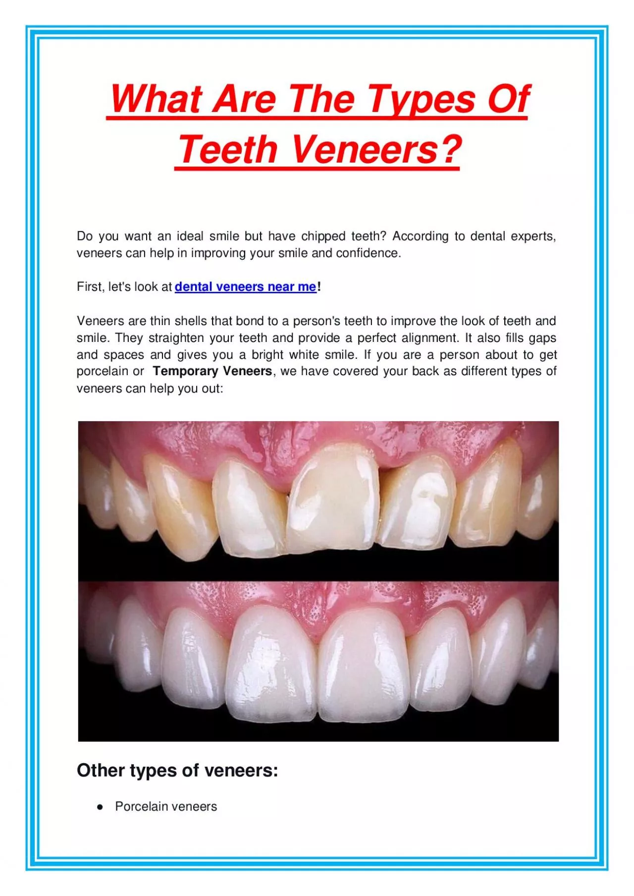 What Are The Types Of Teeth Veneers?