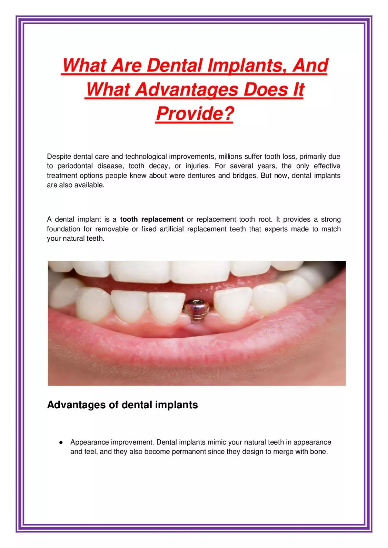 What Are Dental Implants, And What Advantages Does It Provide?