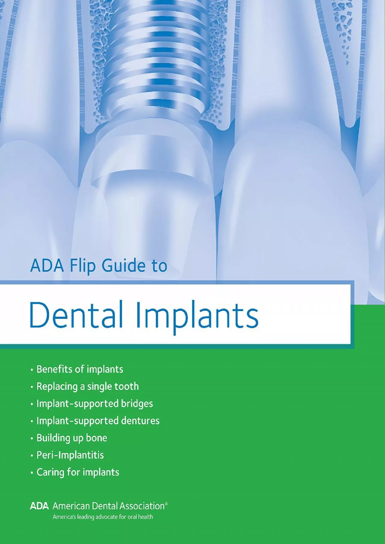 PDF-(BOOK)-ADA Flip Guide to Dental Implants (ADA Flip Guides)