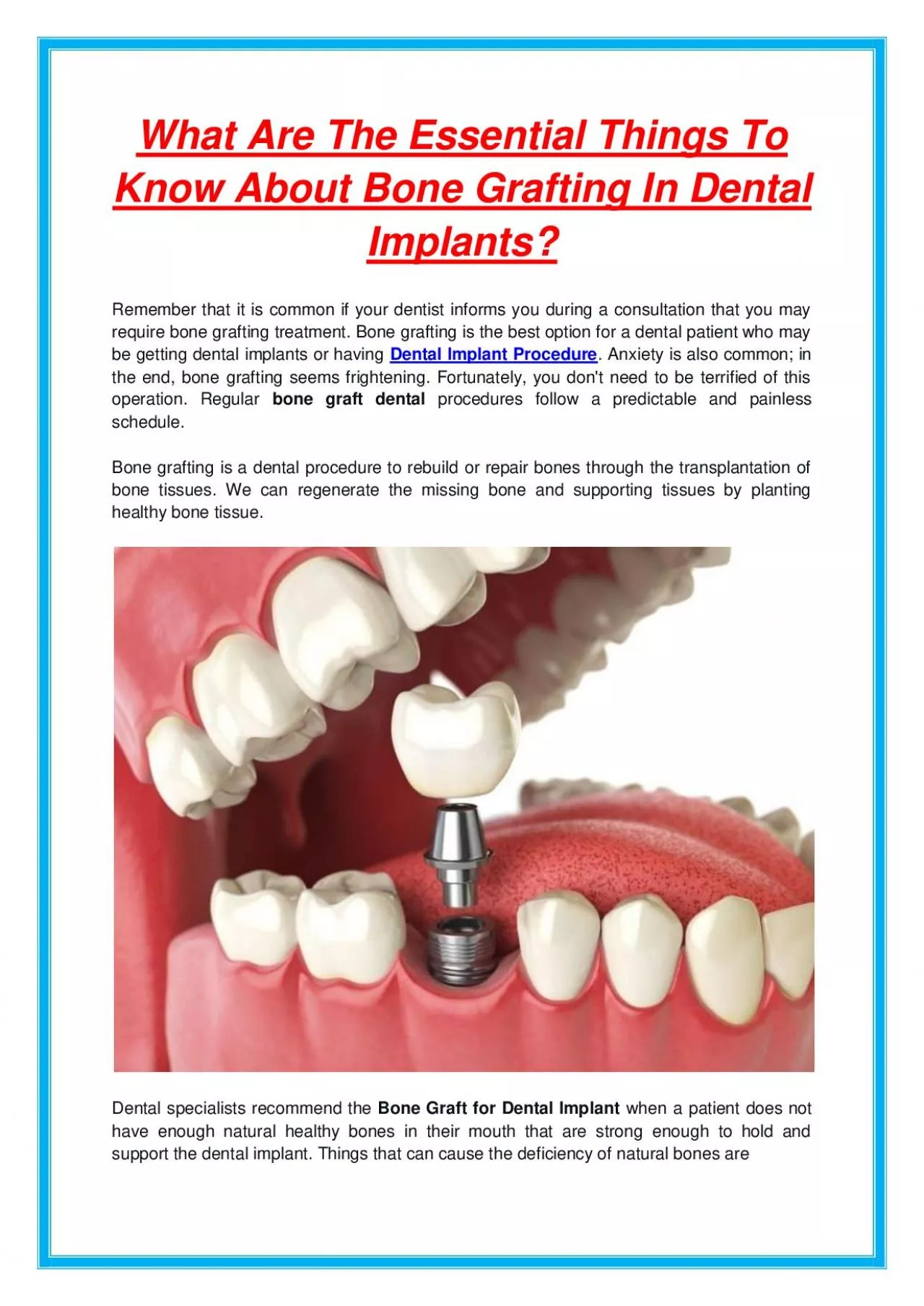 What Are The Essential Things To Know About Bone Grafting In Dental Implants?