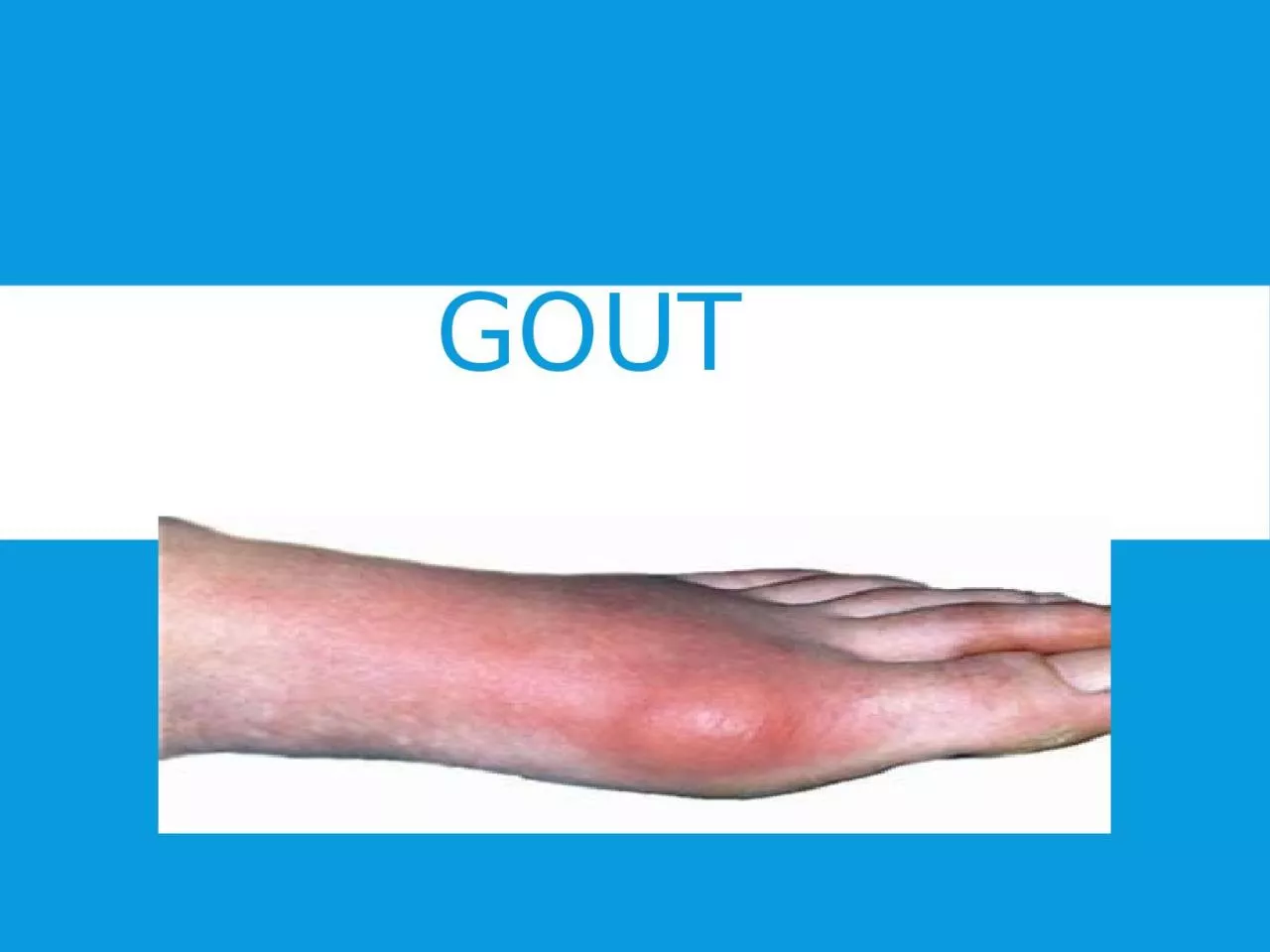 Gout PATHOLOGY  excessive  concentrations of uric acid and some