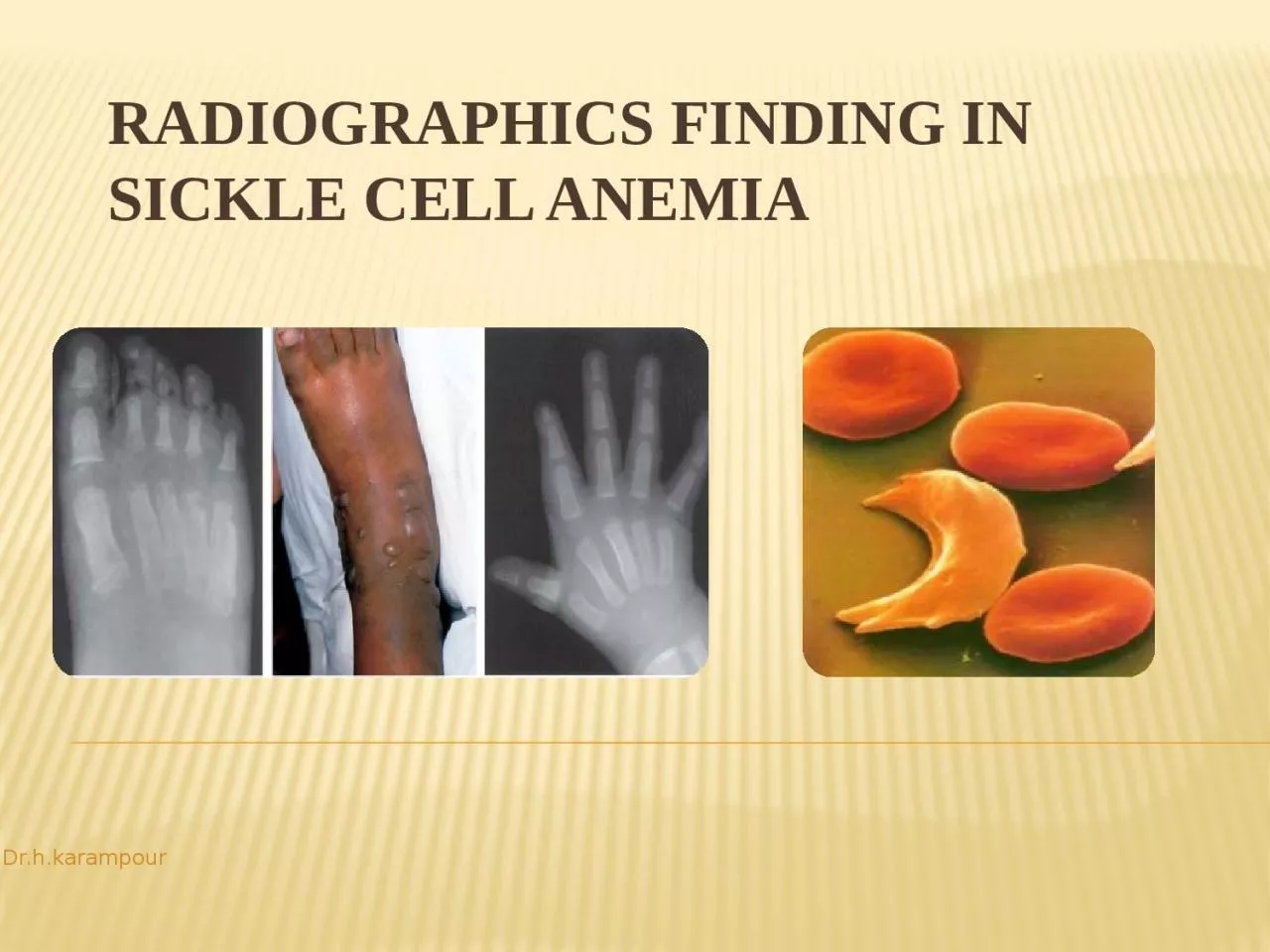 PPT-Radiographics finding in sickle cell anemia