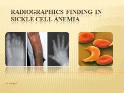 Radiographics  finding in sickle cell anemia